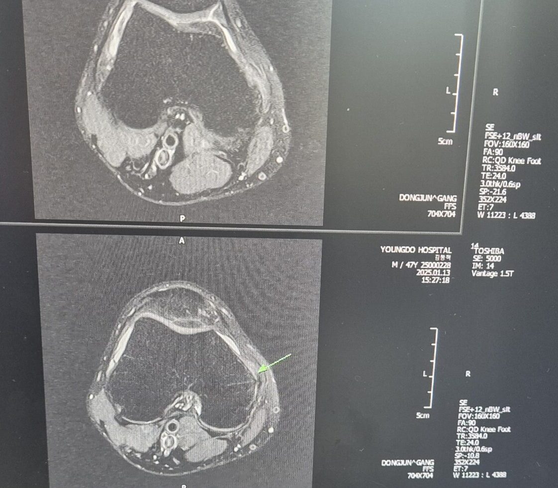 내측인대부분파열 MRI