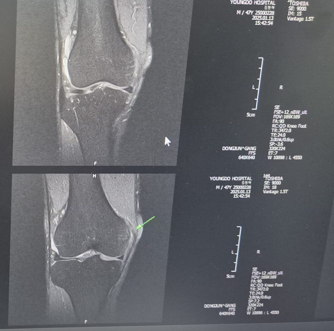 MRI사진 내측인대부분파열